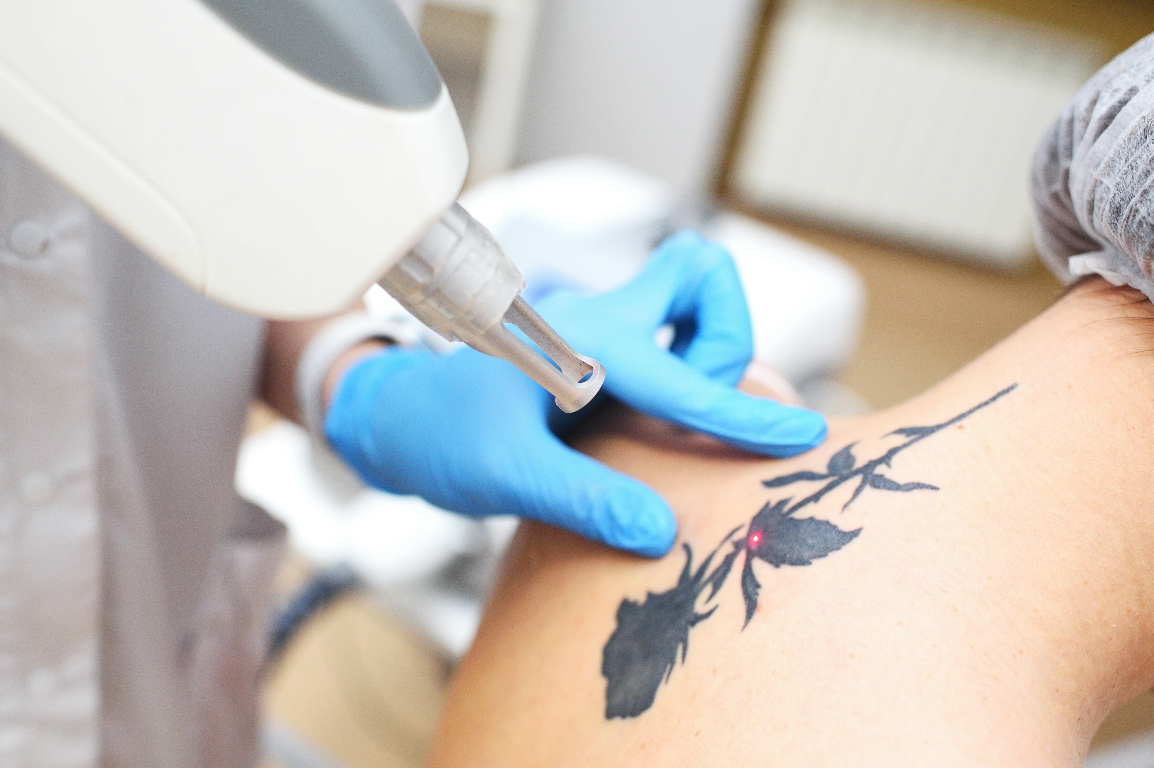 Laser Tattoo Removal in Chandler, AZ