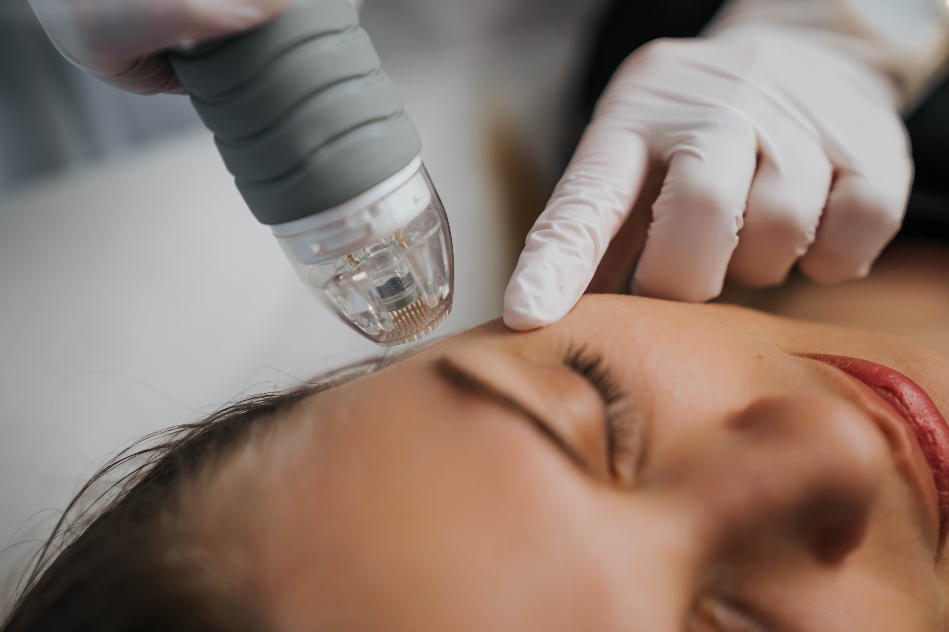 Microneedling in Chandler, AZ
